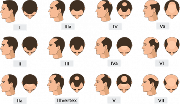 Evolution de la calvitie